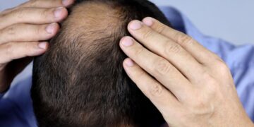 Bazı yiyeceklerin saç dökülmesine neden olabileceği ortaya çıktı