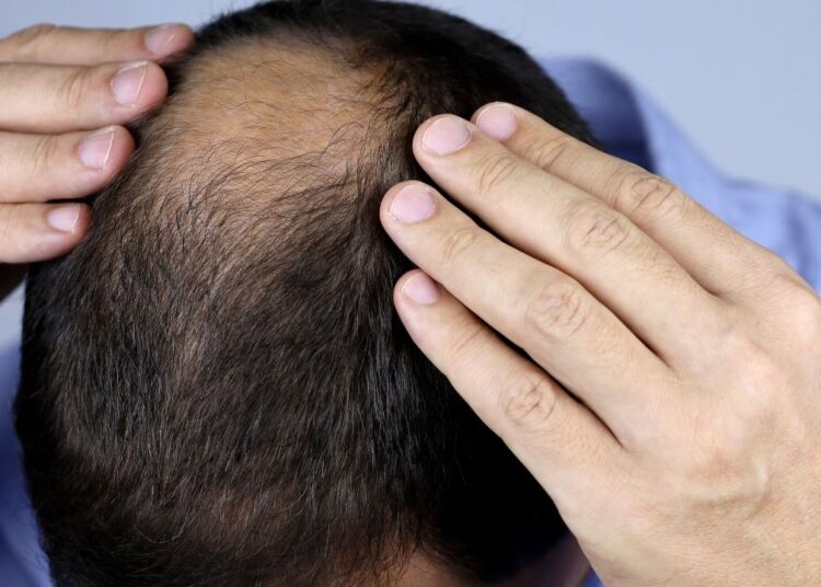 Bazı yiyeceklerin saç dökülmesine neden olabileceği ortaya çıktı